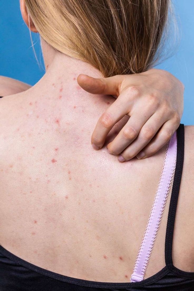 Pourquoi a-t-on souvent des boutons au retour des vacances ? (Et nos conseils pour y remédier)