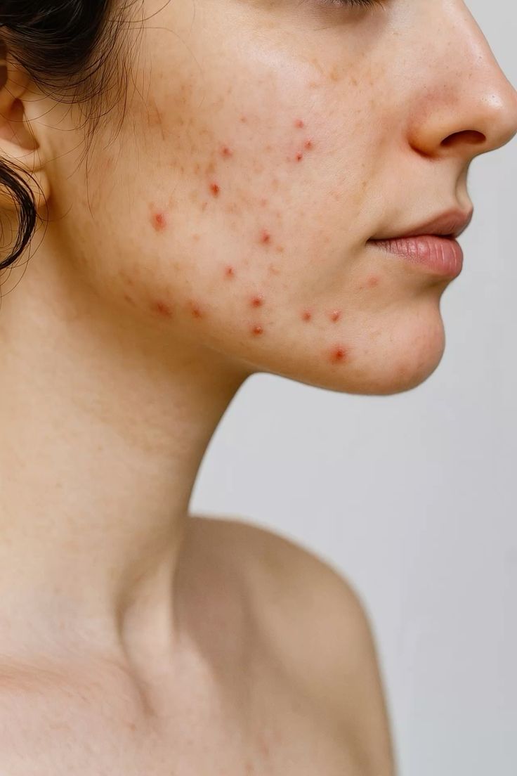 acne-hormonale-femme-adulte-zone-u.jpg