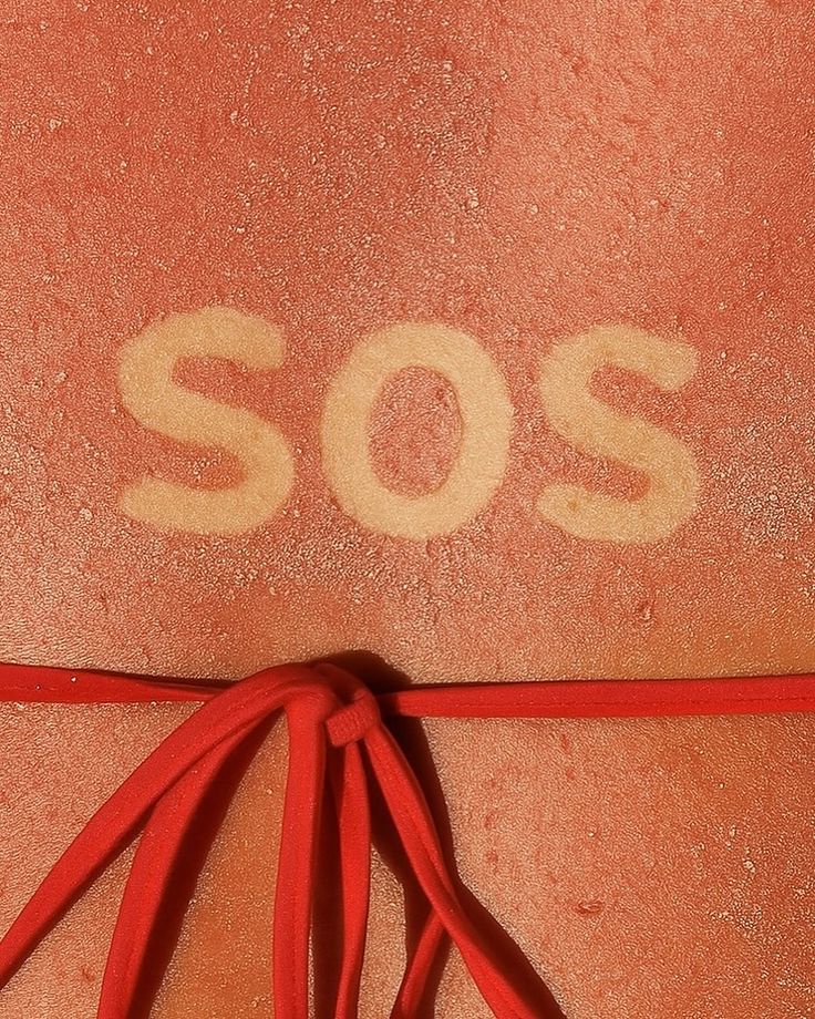 Coup de soleil : comment sauver sa peau et réparer l'épiderme en profondeur